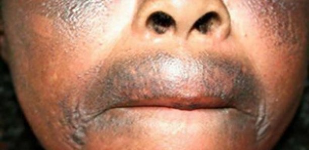  Lutte contre la dépigmentation : Nécessité de taxer les produits