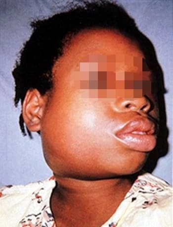  Santé : Comment attrape-t-on les oreillons?