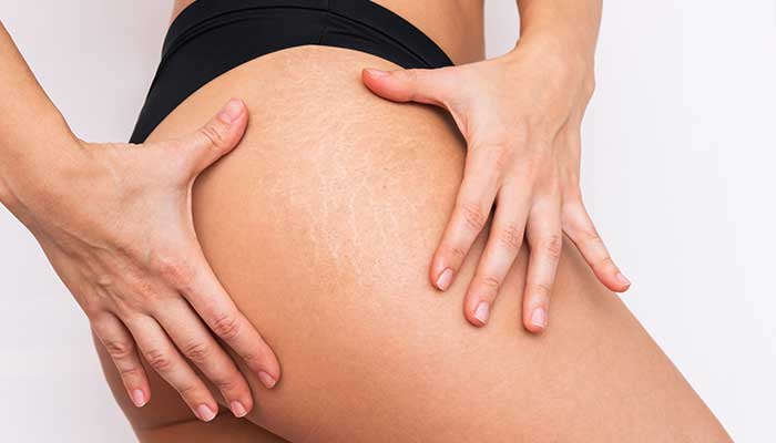  Vergetures: Comment les faire disparaître naturellement