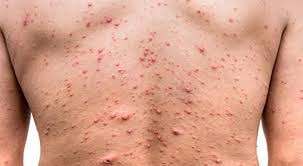  Variole du singe : Le silence du gouvernement