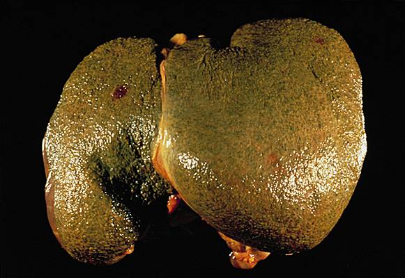  Cirrhose du foie : Tout savoir sur cette maladie silencieuse